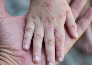 Un niño es la primera víctima del renuevo de sarampión en Estados Unidos, en casi una década
