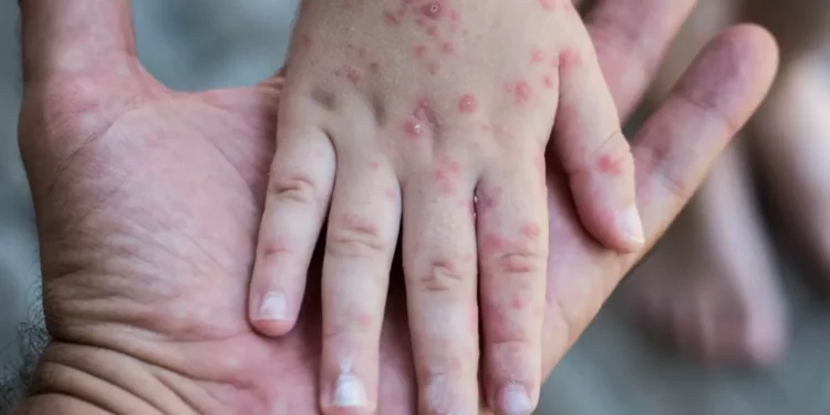 Un niño es la primera víctima del renuevo de sarampión en Estados Unidos, en casi una década