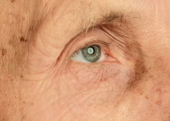 ¿Qué son las cataratas, como se detectan, qué molestias producen y cómo se tratan?